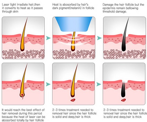 what is 808nm laser hair removal and how to work? - LINGMEI ...