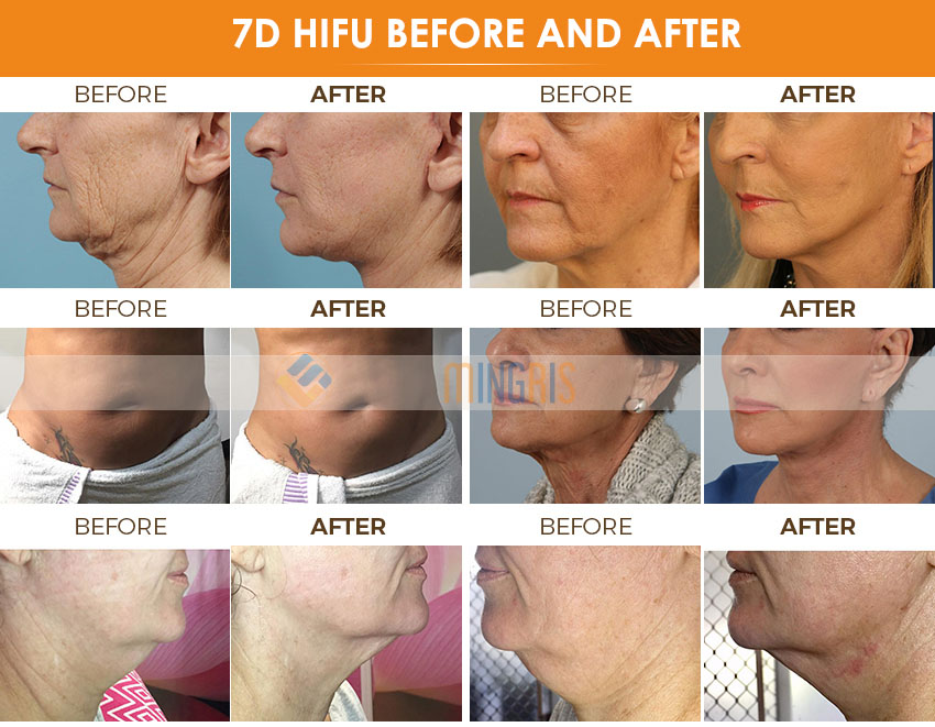 FU4.5 9SE 7D Hifu beauty machine 7 Cartridges Anti Wrinkle Face Lift Skin Tightening Body Slimming 7D Hifu Machine 14 1