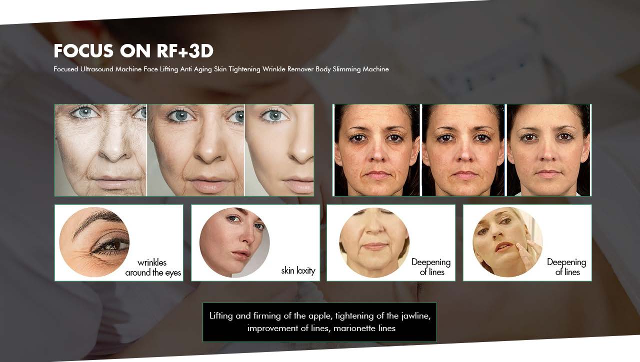 FU4.5 9SC ultramatrix rf 9