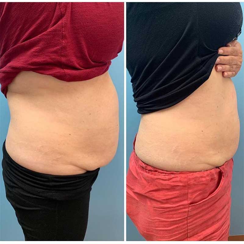 emslim hiemt pro results 1 3