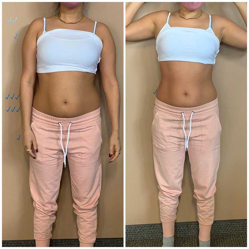 emslim hiemt pro results 1 4