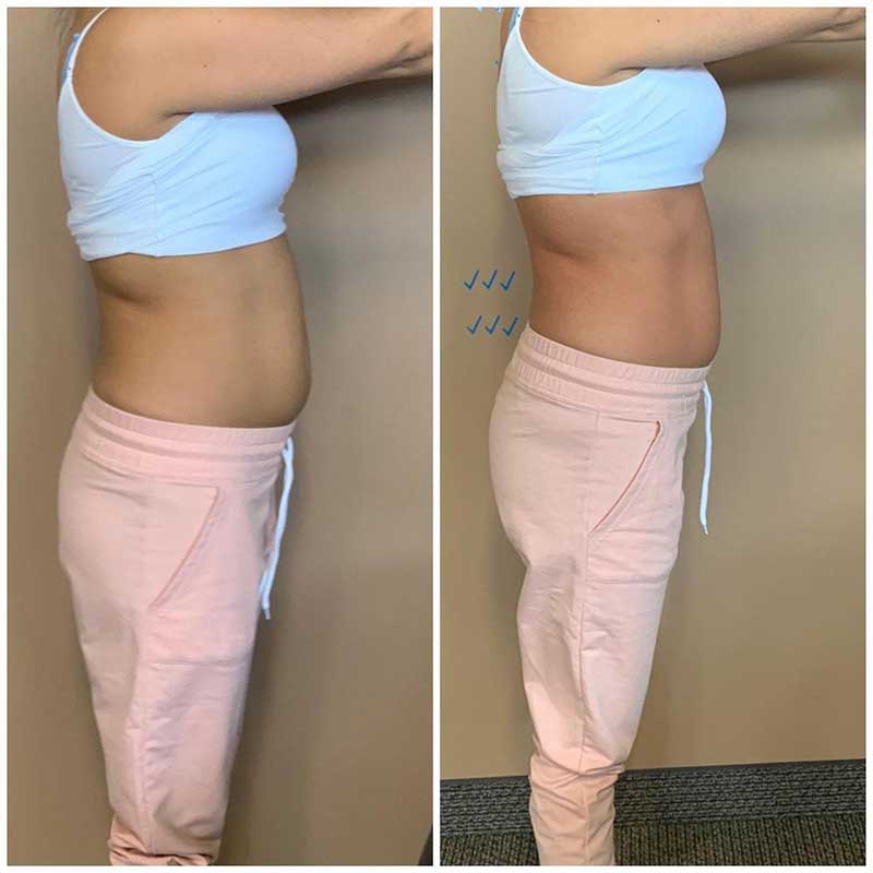 emslim hiemt pro results 1 5