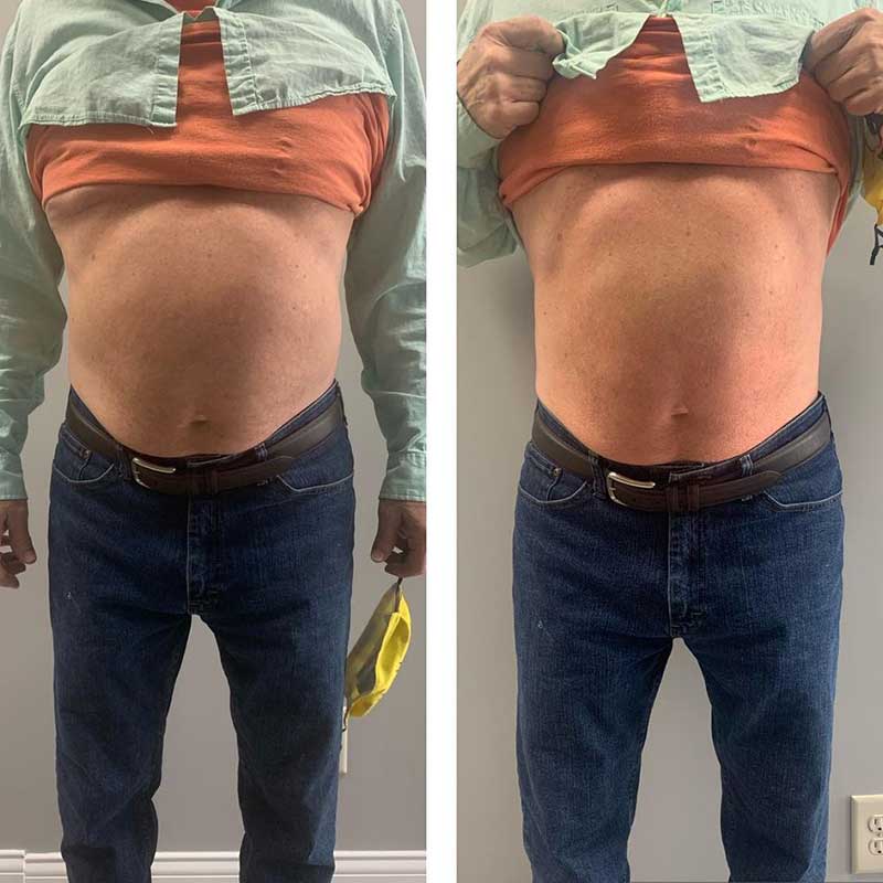 emslim hiemt pro results 1 6