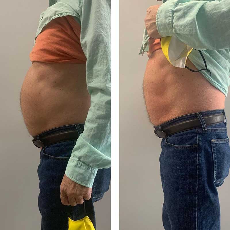 emslim hiemt pro results 1 7