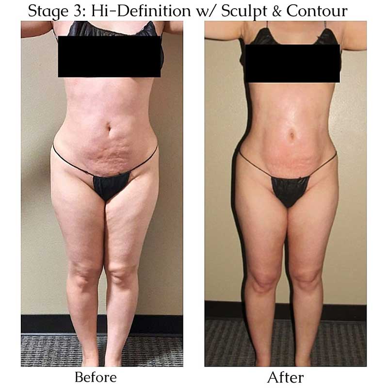 emslim hiemt pro before and after results 1 1