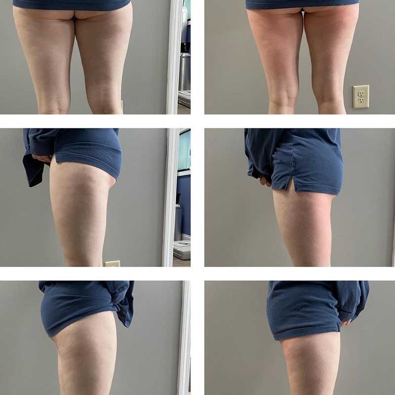 emslim hiemt pro before and after results 1 8