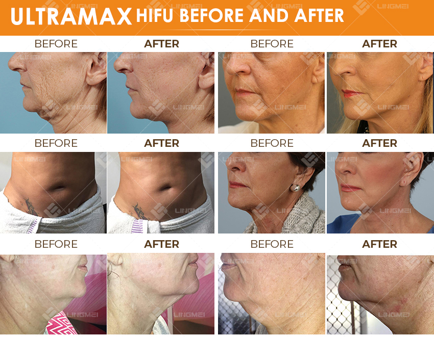 FU4.5 9SH ultramax hifu 11