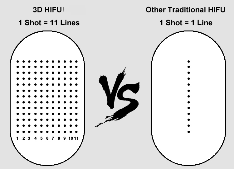 FU4.5 9S 3D HIFU 18