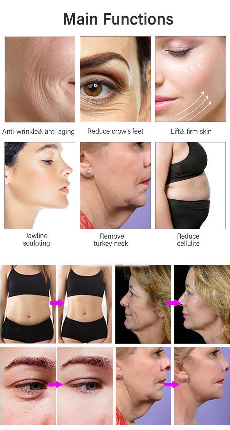 FU4.5E focused rf hifu 3d machine 12