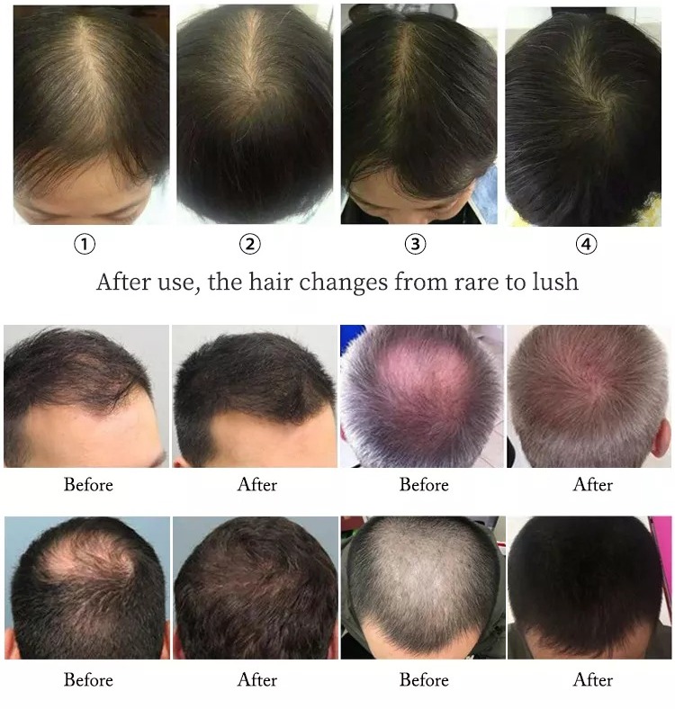 LR01 hair regrowth 9