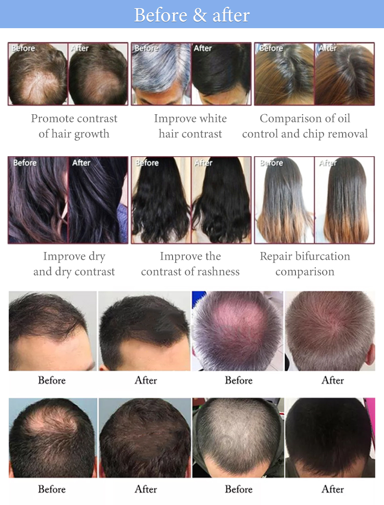 HAIR REGROWTH MACHINE WITH BEFORE AND AFTER